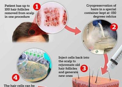 بانک فولیکول مو مشکل ریزش مو را حل خواهد کرد بانک فولیکول مو مشکل ریزش مو را حل خواهد کرد